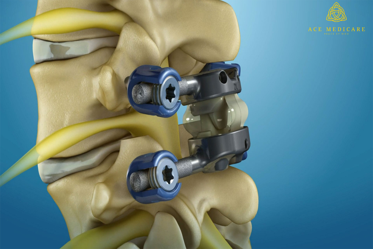 Spine Surgery with Minimal Invasive Techniques